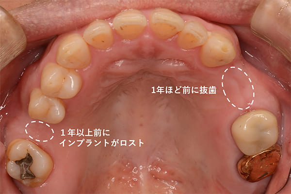 上顎左右フラップレス 術前咬合面
