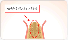 スプリットクレスト